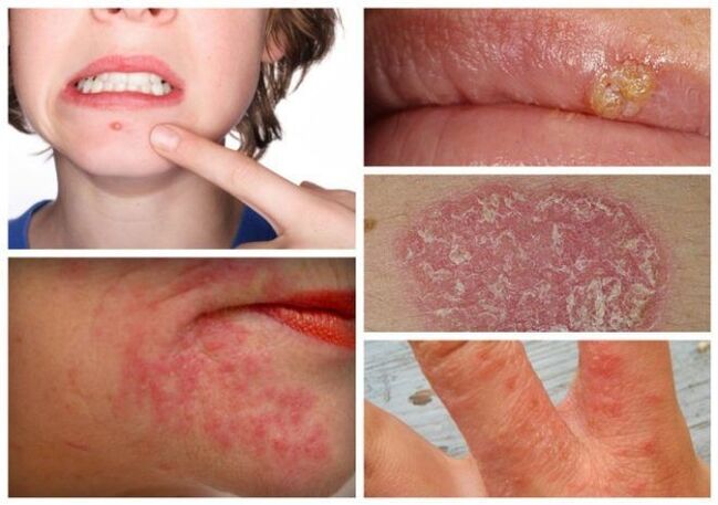 Allergien und Hautkrankheiten sind Anzeichen von Parasiten im Körper