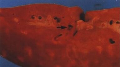 Welche Parasiten können in der menschlichen Leber leben